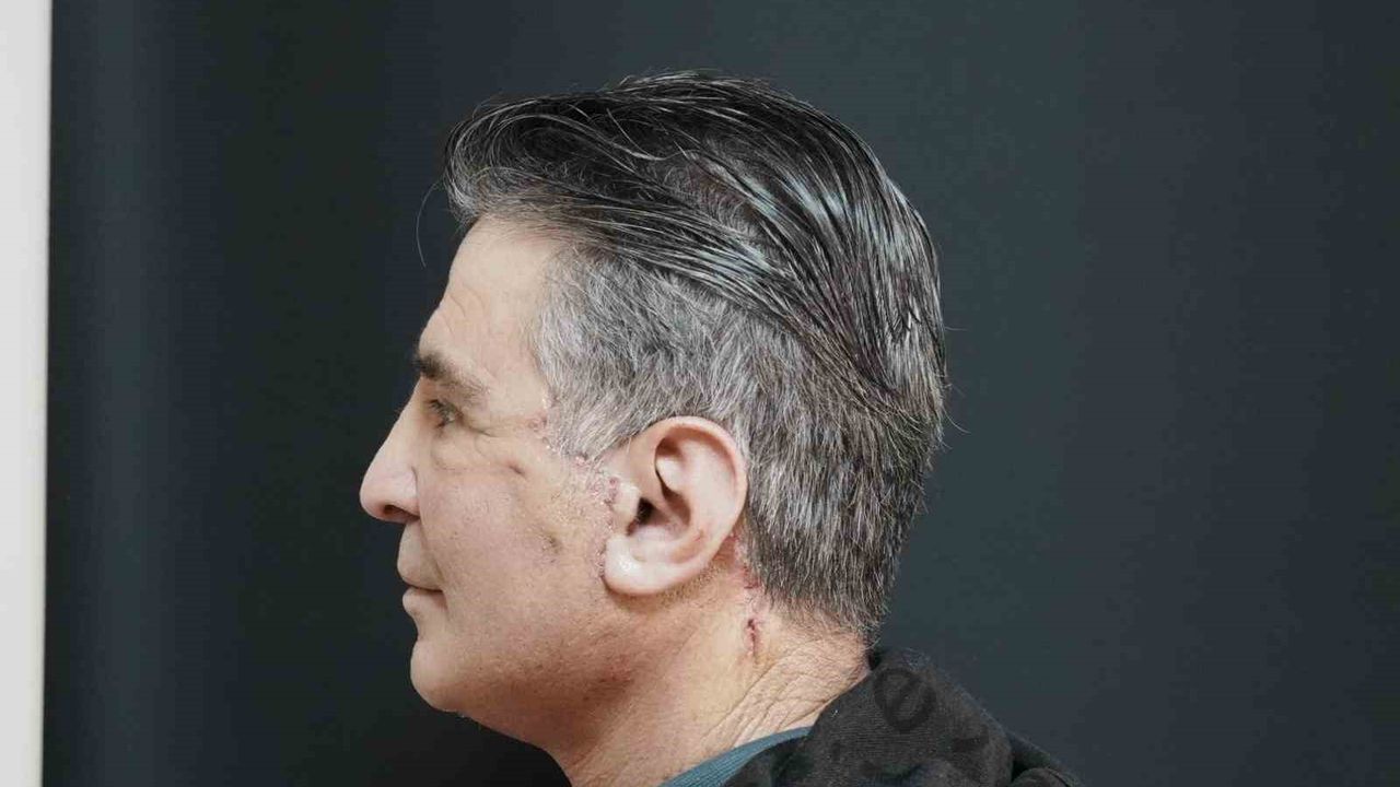 Bitlis'te ilk defa yüz germe ameliyatı başarıyla yapıldı