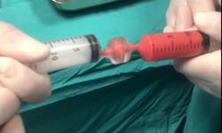 16 yıl bezle yaşamını sürdüren Sıla, ilk kez uygulanan yöntemle sağlığına kavuştu