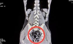 Röntgenle tespit edilen uyuşturucu cerrahi operasyonla çıkarıldı