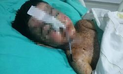 Salatalık yutunca rahatsızlandı; 3 yıl önce vücudunda 18 santimlik kateter unutulduğu ortaya çıktı